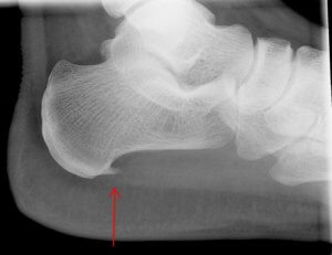 Plantar Fasciitis x-ray