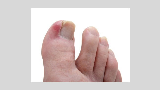 Ingrown Toenails Understanding and Avoiding | North Jersey foot and ankle  center
