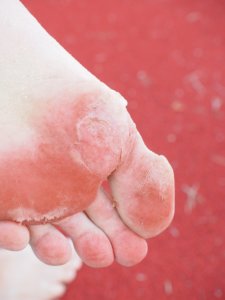Athlete’s Foot